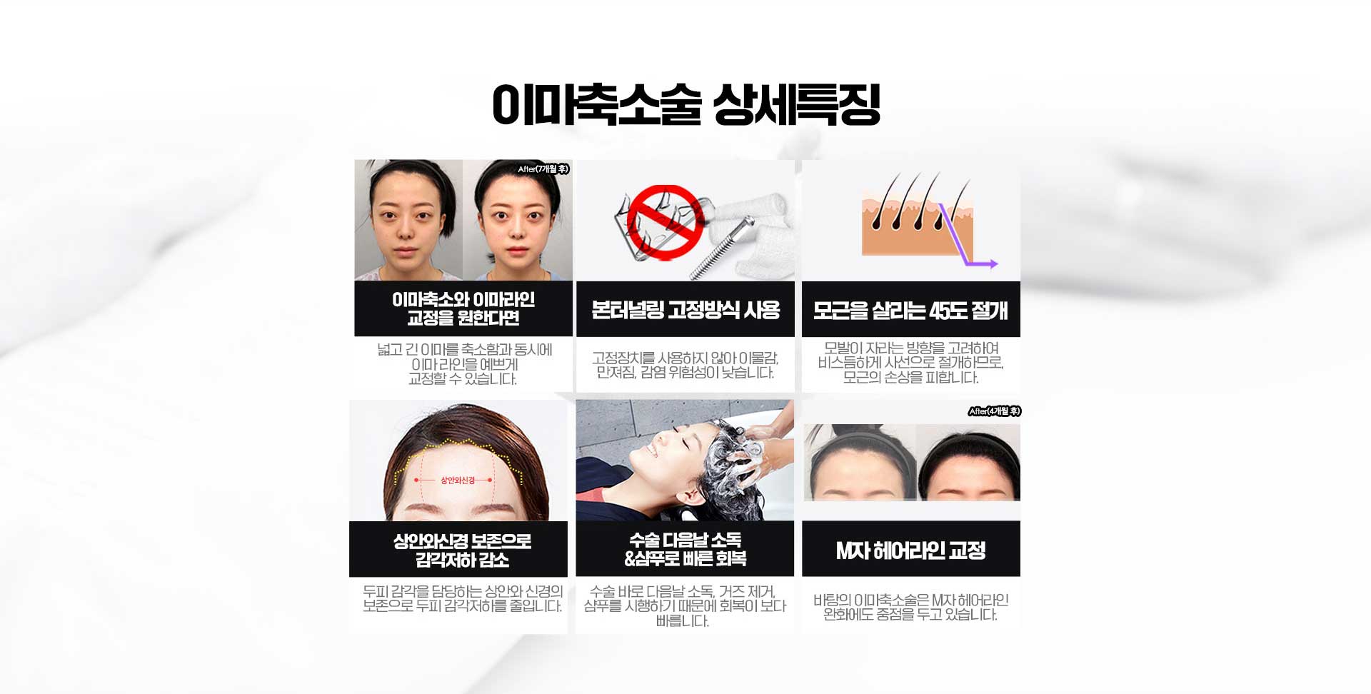이마축소술 상세특징