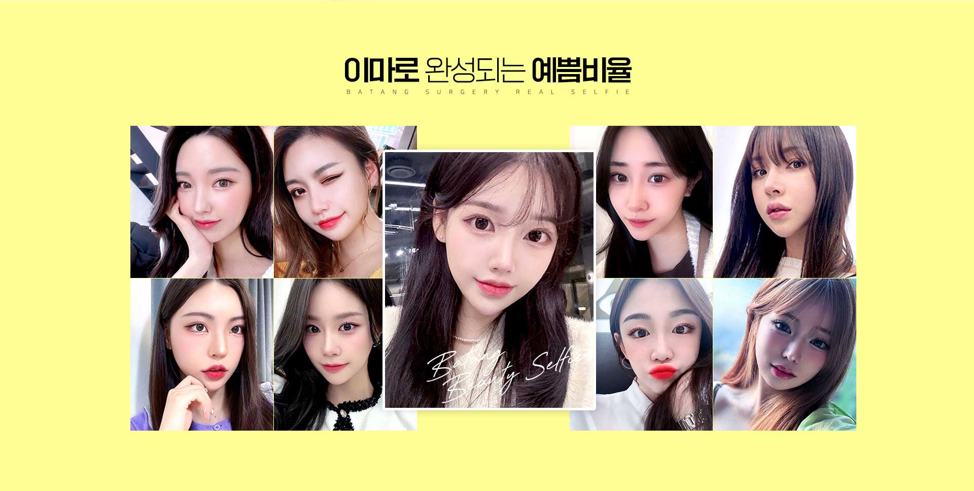 이마축소술 셀피
